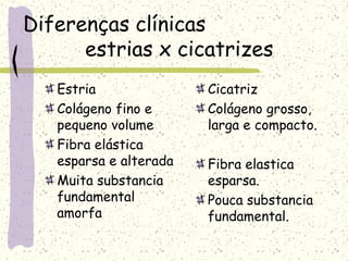 Diferenças clínicas
estrias x cicatrizes
Estria
Colágeno fino e
pequeno volume
Fibra elástica
esparsa e alterada
Muita substancia
fundamental
amorfa
Cicatriz
Colágeno grosso,
larga e compacto.
Fibra elastica
esparsa.
Pouca substancia
fundamental.
 