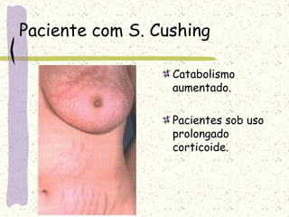 Paciente com S. Cushing
Catabolismo
aumentado.
Pacientes sob uso
prolongado
corticoide.
 