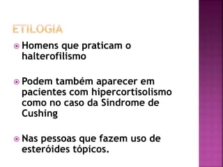  Homens que praticam o
halterofilismo
 Podem também aparecer em
pacientes com hipercortisolismo
como no caso da Síndrome de
Cushing
 Nas pessoas que fazem uso de
esteróides tópicos.
 