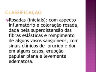 Rosadas (iniciais): com aspecto
inflamatório e coloração rosada,
dada pela superdistensão das
fibras eslásticas e rompimento
de alguns vasos sanguíneos, com
sinais clínicos de prurido e dor
em alguns casos, erupção
papular plana e levemente
edematosa.
 