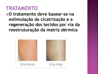 O tratamento deve basear-se na
estimulação da cicatrização e a
regeneração dos tecidos por via da
reestruturação da matriz dérmica
 