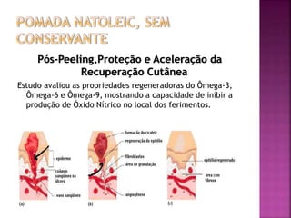Pós-Peeling,Proteção e Aceleração da
Recuperação Cutânea
Estudo avaliou as propriedades regeneradoras do Ômega-3,
Ômega-6 e Ômega-9, mostrando a capacidade de inibir a
produção de Óxido Nítrico no local dos ferimentos.
 