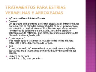  Infravermelho + Ácido retinoico
 Como é?
Um aparelho com ponteira de cristal dispara raios infravermelhos
que aquecem as camadas mais profundas da pele, provocando a
sua retração e produzindo mais fibroblastos, que são as células
formadoras do colágeno e da elastina. Meia hora depois é
aplicado o ácido retinoico, que também estimula o aumento das
fibras de sustentação da pele.
 O que esperar?
Três meses após o tratamento, o aspecto das linhas melhora
entre 40% e 80%, dependendo da largura.
 Dói?
O desconforto do infravermelho é suportável. A coloração das
estrias fica mais intensa nos primeiros dias e vai clareando aos
poucos.
 Número de sessões
No mínimo três, uma por mês.
 