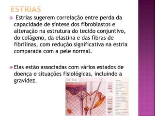  Estrias sugerem correlação entre perda da
capacidade de síntese dos fibroblastos e
alteração na estrutura do tecido conjuntivo,
do colágeno, da elastina e das fibras de
fibrilinas, com redução significativa na estria
comparada com a pele normal.
 Elas estão associadas com vários estados de
doença e situações fisiológicas, incluindo a
gravidez.
 