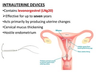 INTRAUTERINE DEVICES
•Contains levonorgestrel (LNg20)
Effective for up to seven years
•Acts primarily by producing uterine changes
•Cervical mucus thickening
•Hostile endometrium
 