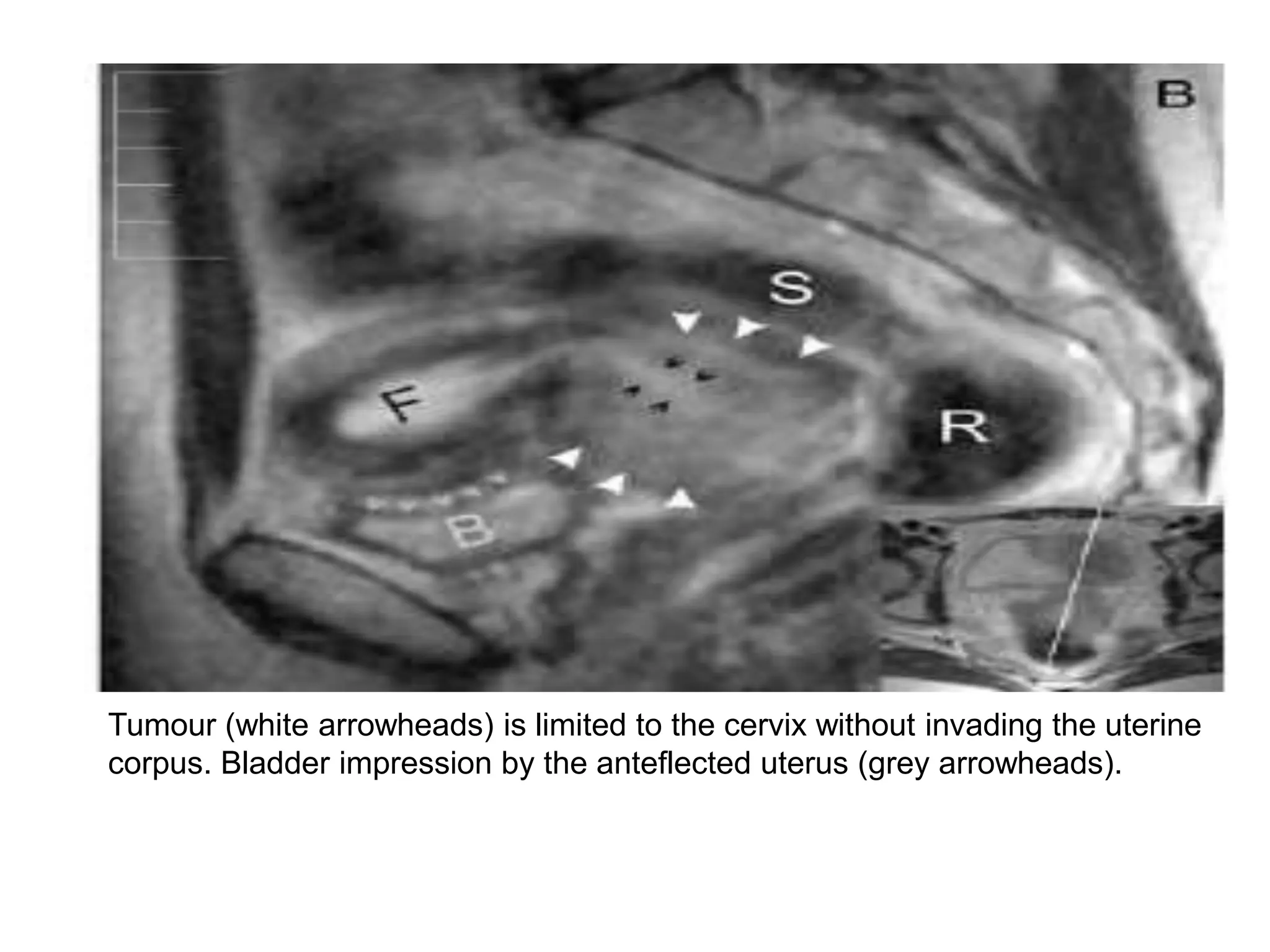 Estro_revised brachy therapy cervical .ppt