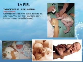 LA PIEL
VARIACIONES DE LA PIEL NORMAL:
Según la edad:
En el recién nacido: Fina, suave, delicada, de
color rojizo, Vello muy fino y abundante sobre
todo en hombros y espalda (lanugo).

 