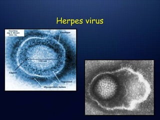 Herpes virus
 