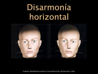 Disarmonía
     horizontal




Fradeani. Rehabilitación estética en prostodoncia ﬁja. Quintessence. 2006.
 
