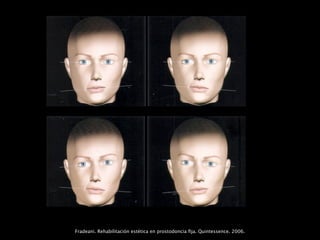Fradeani. Rehabilitación estética en prostodoncia ﬁja. Quintessence. 2006.
 