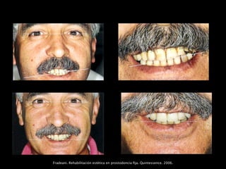 Fradeani. Rehabilitación estética en prostodoncia ﬁja. Quintessence. 2006.
 