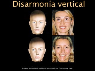 Disarmonía vertical




  Fradeani. Rehabilitación estética en prostodoncia ﬁja. Quintessence. 2006.
 