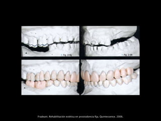 Fradeani. Rehabilitación estética en prostodoncia ﬁja. Quintessence. 2006.
 