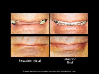 Situación
Situación inicial
                                                              ﬁnal

   Fradeani. Rehabilitación estética en prostodoncia ﬁja. Quintessence. 2006.
 