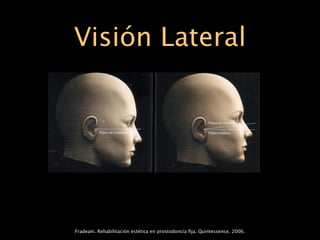 Visión Lateral




Fradeani. Rehabilitación estética en prostodoncia ﬁja. Quintessence. 2006.
 