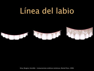 Línea del labio




Kina, Brugera. Invisible - restauraciones estéticas cerámicas. Dental Press. 2008.
 