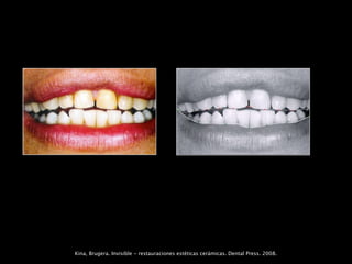 Kina, Brugera. Invisible - restauraciones estéticas cerámicas. Dental Press. 2008.
 