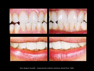 Kina, Brugera. Invisible - restauraciones estéticas cerámicas. Dental Press. 2008.
 