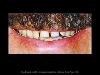Kina, Brugera. Invisible - restauraciones estéticas cerámicas. Dental Press. 2008.
 