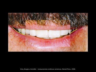 Kina, Brugera. Invisible - restauraciones estéticas cerámicas. Dental Press. 2008.
 