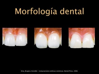 Morfología dental




 Kina, Brugera. Invisible - restauraciones estéticas cerámicas. Dental Press. 2008.
 
