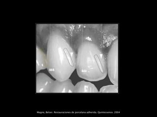Magne, Belser. Restauraciones de porcelana adherida. Quintessence. 2004
 