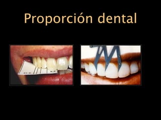 Proporción dental
 