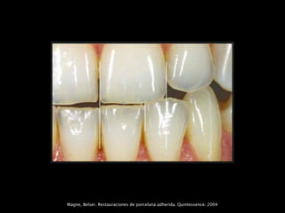 Magne, Belser. Restauraciones de porcelana adherida. Quintessence. 2004
 