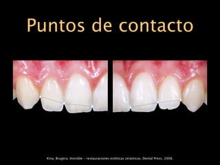Puntos de contacto




  Kina, Brugera. Invisible - restauraciones estéticas cerámicas. Dental Press. 2008.
 