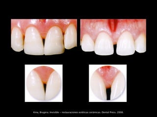 Kina, Brugera. Invisible - restauraciones estéticas cerámicas. Dental Press. 2008.
 