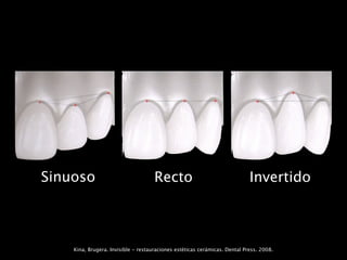 Sinuoso                              Recto                                  Invertido



    Kina, Brugera. Invisible - restauraciones estéticas cerámicas. Dental Press. 2008.
 