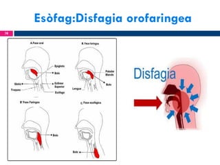 Esòfag:Disfagia orofaringea
38

 