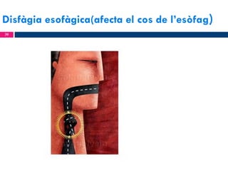 Disfàgia esofàgica(afecta el cos de l’esòfag)
39

 