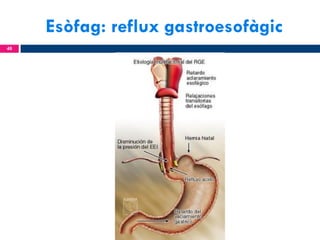 Esòfag: reflux gastroesofàgic
40

 