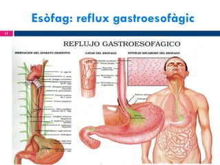 Esòfag: reflux gastroesofàgic
41

 
