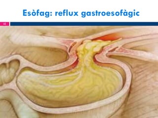 Esòfag: reflux gastroesofàgic
42

 