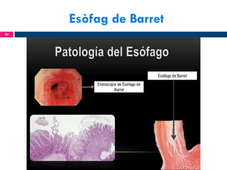 Esòfag de Barret
44

 