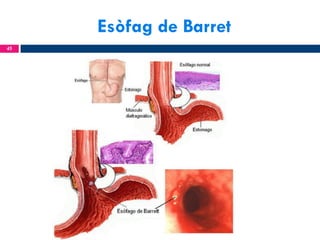 Esòfag de Barret
45

 
