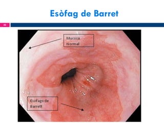 Esòfag de Barret
46

 