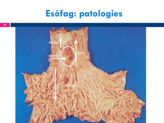 Esòfag: patologies
48

 