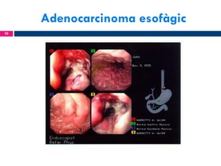 Adenocarcinoma esofàgic
50

 
