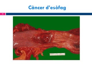 Càncer d’esòfag
51

 