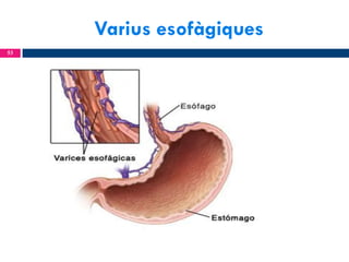 Varius esofàgiques
53

 