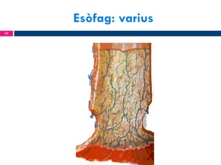 Esòfag: varius
54

 