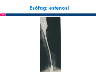 Esòfag: estenosi
58

 