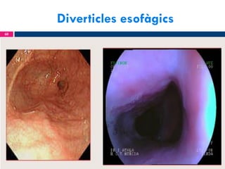 Diverticles esofàgics
60

 