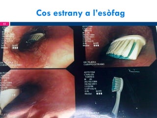 Cos estrany a l’esòfag
61

 