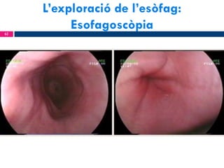 L’exploració de l’esòfag:
Esofagoscòpia
62

 