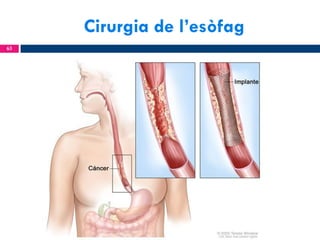 Cirurgia de l’esòfag
63

 