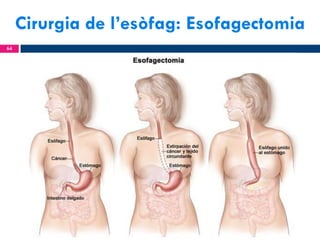 Cirurgia de l’esòfag: Esofagectomia
64

 